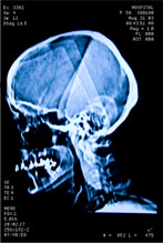 A Serious Head Injury Is Not Always Readily Apparent 