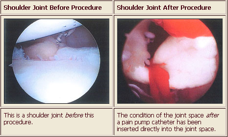 Before and after pain pump insertion