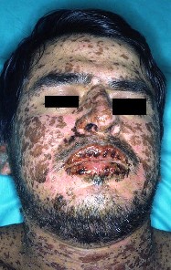 Person with dark skin lesions and ulcers on face and lips; eyes are blacked out for privacy.