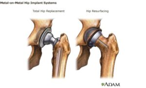 Illustration comparing total hip replacement and hip resurfacing metal-on-metal implants.