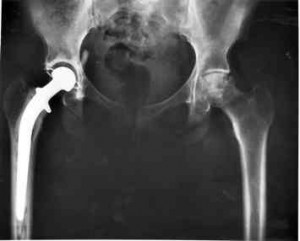 X-ray showing a hip replacement on the left side of the pelvis.