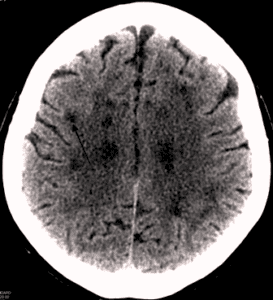 CT scan of a human brain showing gray and white matter in drug-induced leukoencephalopathy.