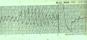 Electrocardiogram strip showing ventricular tachycardia transitioning to normal rhythm.