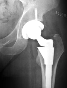 X-ray image showing a hip joint replacement with orthopedic implant components.