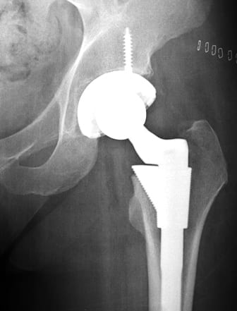 metal on metal hip replacement defect