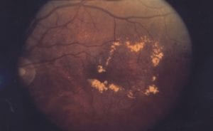diabetic macular edema scan