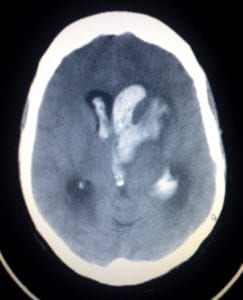 CT scan of a brain showing areas of bleeding and abnormal white regions.