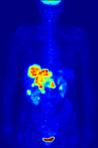 PET scan image showing areas of high metabolic activity in the abdominal region.