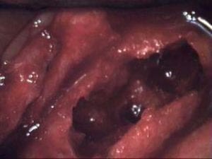Endoscopic view of a gastric ulcer with dark, irregular tissue and inflamed surrounding mucosa.