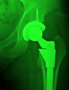 X-ray of a hip joint showing a metal hip replacement implant.