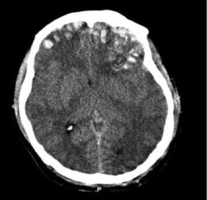 CT scan of brain showing multiple round lesions along the inside of the skull.