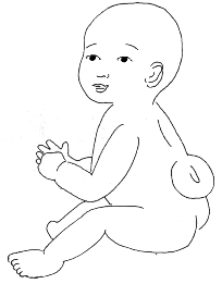 A rough sketch of a baby with spina bifida. 