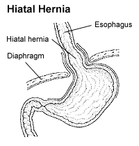 This picture shows a diagram of a hiatal hernia. 