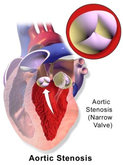 Aortic Stenosis by Bruce Blaus