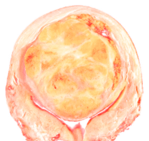 Leiomyoma_of_the_Uterus