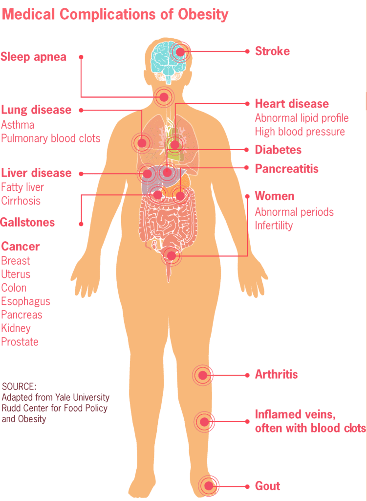 Obesity is one of the purported side effects of BPA ingestion. 