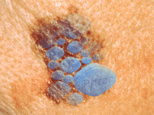 skin cancer melanoma