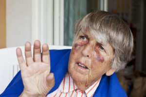 Elderly person with facial bruises raises a hand indoors, suggesting possible elder abuse.