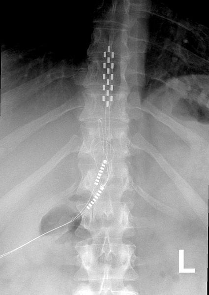 spinal fusion stimulator