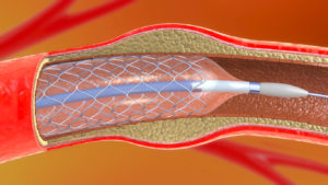 3d illustration of stent implantation for supporting blood circulation into blood vessels