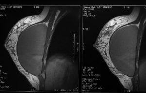 MRI scan of a human breast showing cross-section and internal tissue structure.