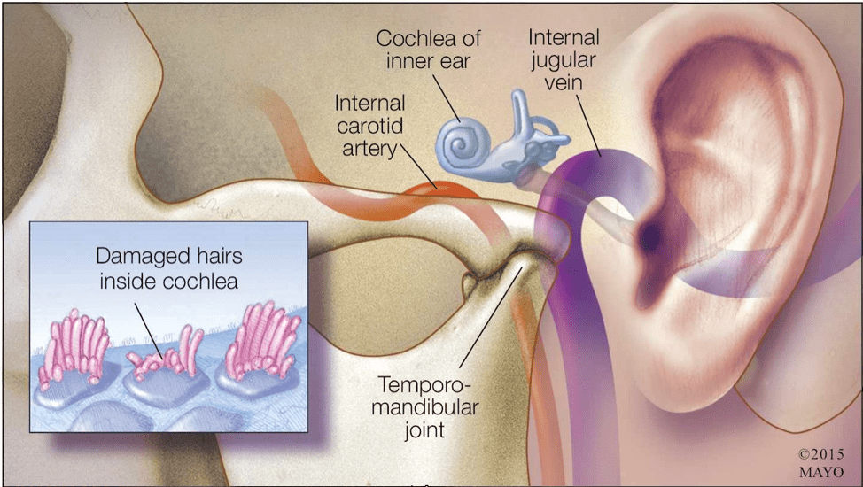 Diagram of ear anatomy showing cochlea, veins, arteries, joint, and damaged hairs in cochlea.