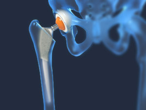 Exactech hip replacement