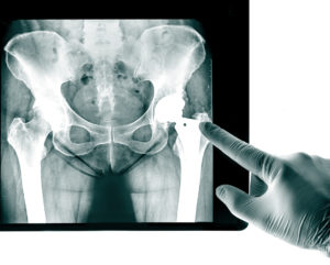 Gloved hand points at hip joint on pelvic X-ray image.