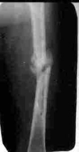 X-ray image of a fractured bone with a visible break near the center.